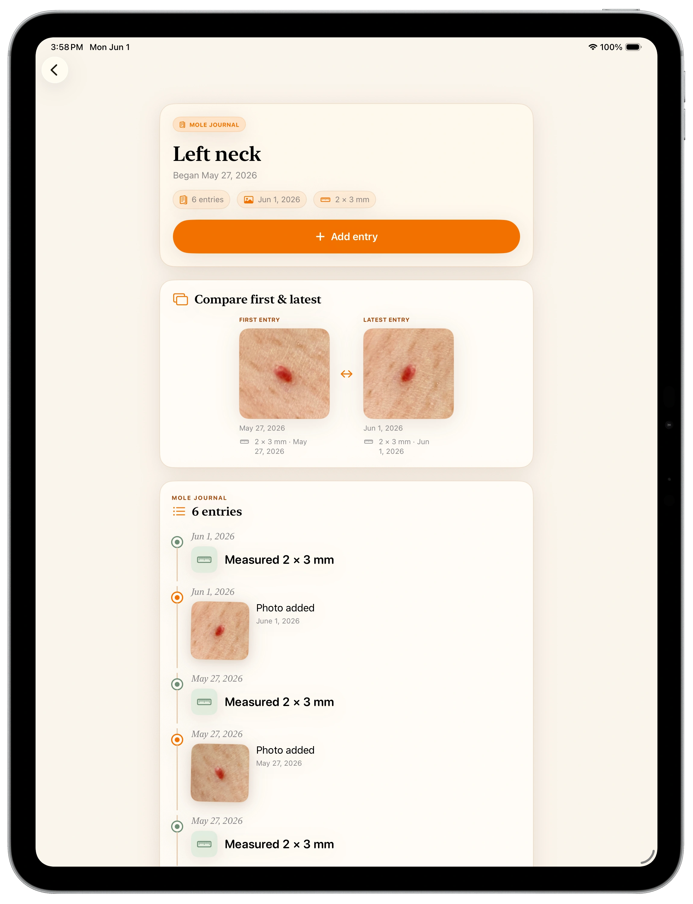 A mole's dated timeline on iPad showing photos and measurements