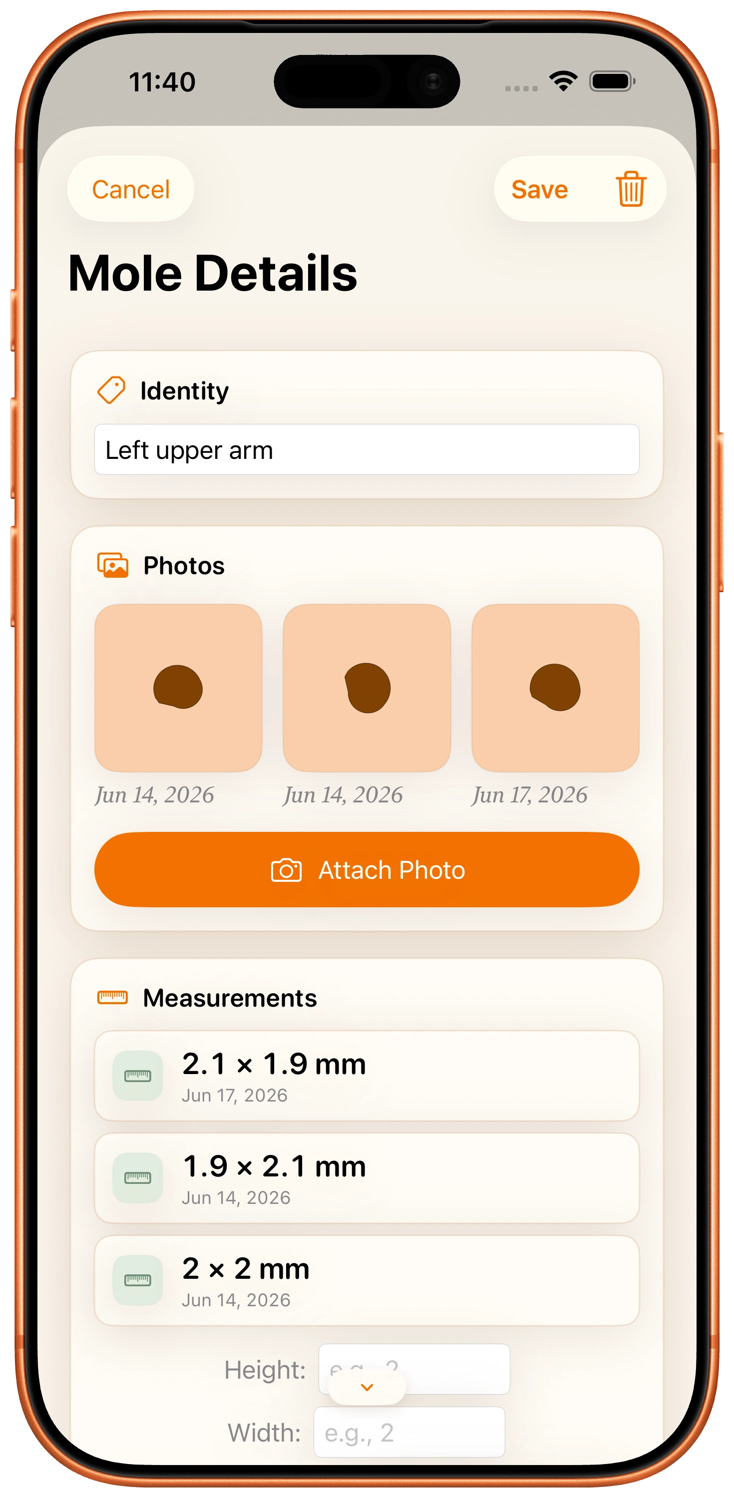 MoleJournal mole details editor on iPhone
