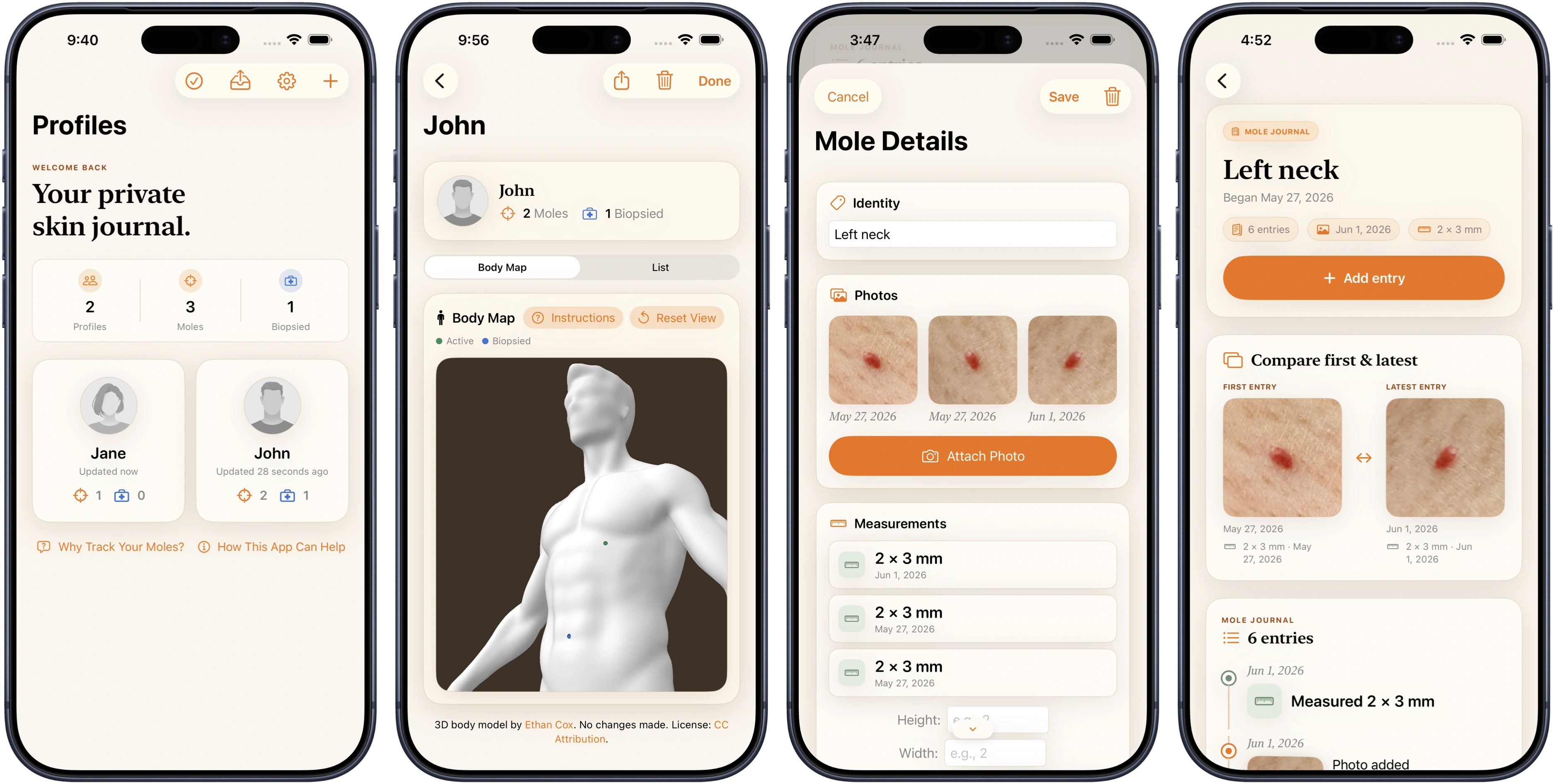 Stacked MoleJournal iPhone screens showing private skin records